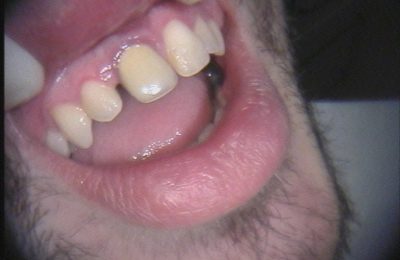Odontoiatria estetica: caso 2 - Prima © Dott. Alessandro Negri